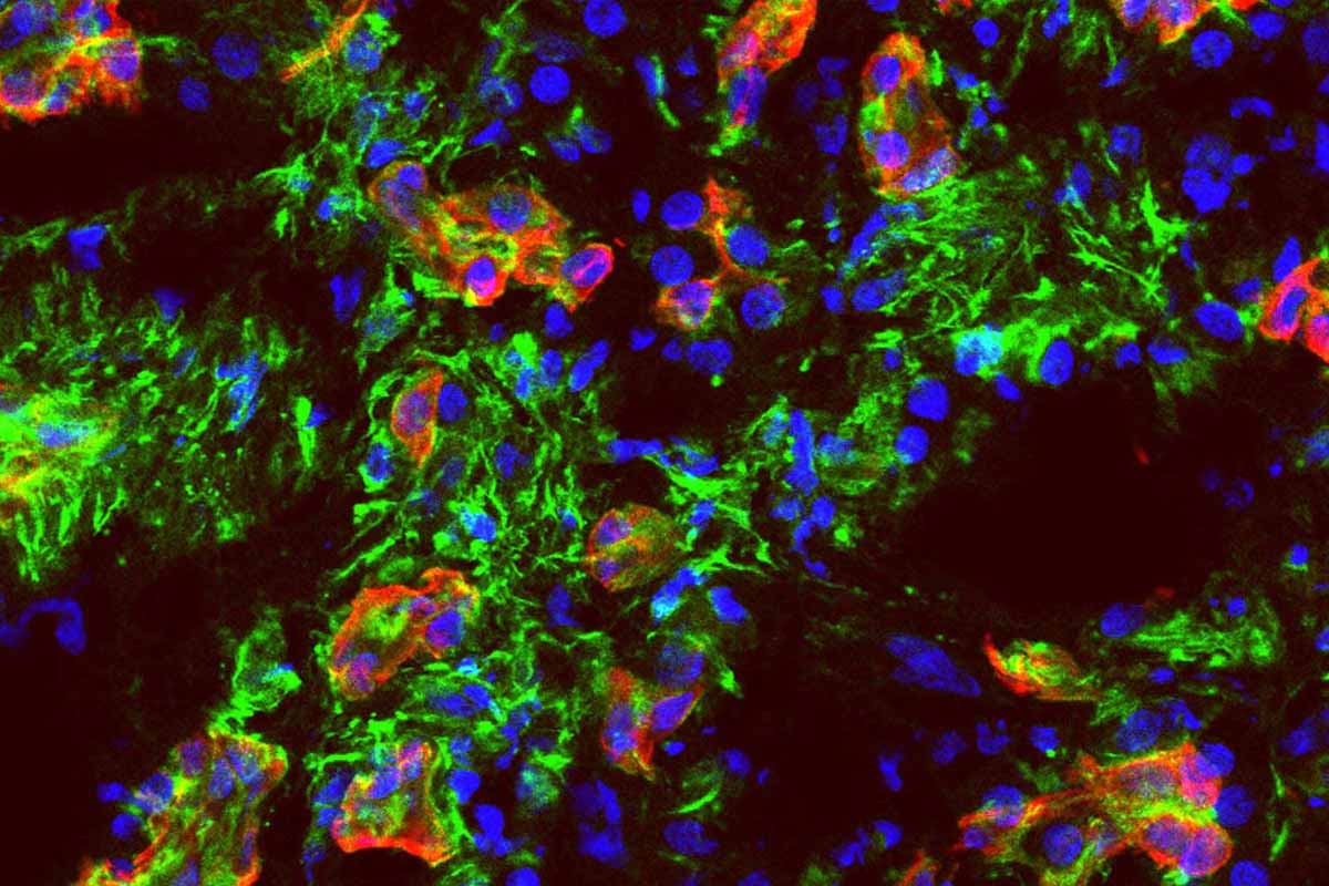 Key driver of pancreatic cancer spread unmasked