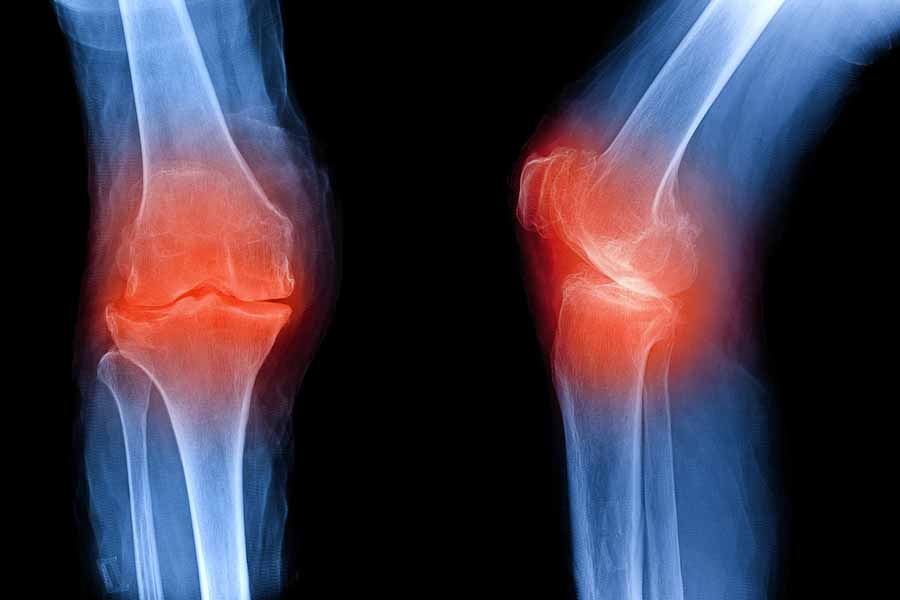 knee osteoarthritis